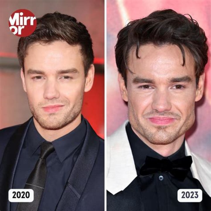 Liam Payne's Journey Through Jaw Surgery: A Story of Resilience and Recovery