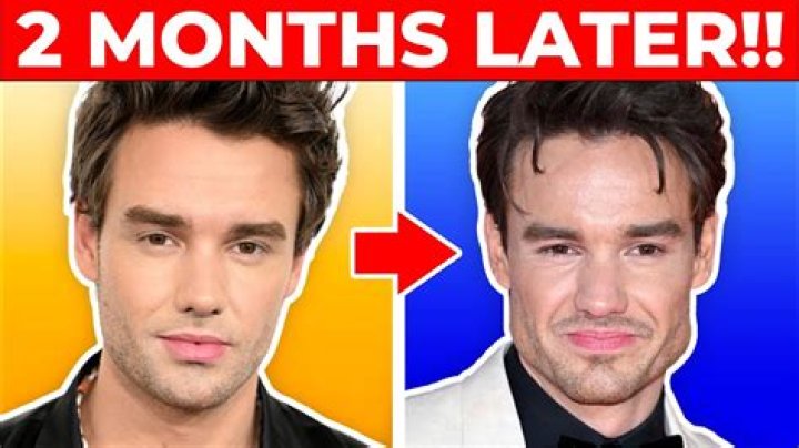 Liam Payne's Transformation: The Truth Behind His Face Plastic Surgery