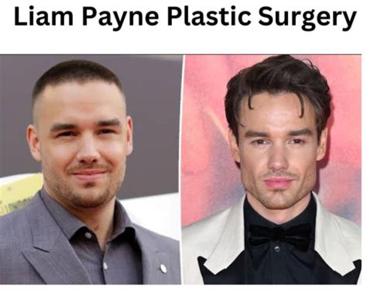 Unveiling the Truth: Did Liam Payne Have Plastic Surgery?